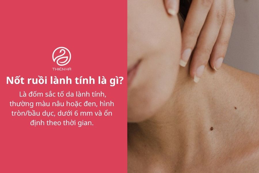 Nốt ruồi lành tính: Phân biệt với ác tính và cách xử lý đúng 1 Nốt ruồi lành tính là gì?
