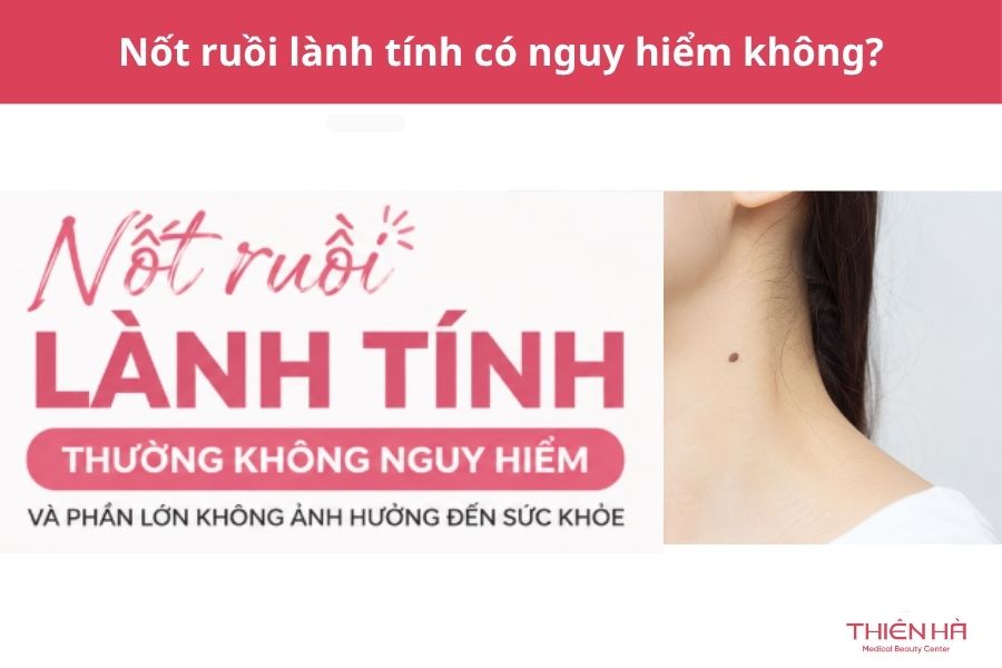 Nốt ruồi lành tính: Phân biệt với ác tính và cách xử lý đúng 4 Nốt ruồi lành tính có nguy hiểm không?