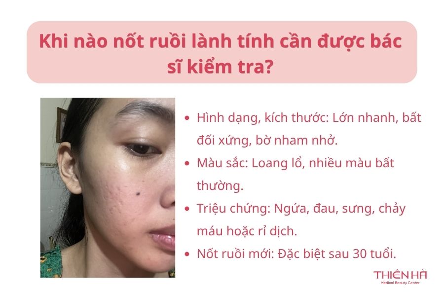 Nốt ruồi lành tính: Phân biệt với ác tính và cách xử lý đúng 5 Khi nào nốt ruồi lành tính cần được bác sĩ kiểm tra?