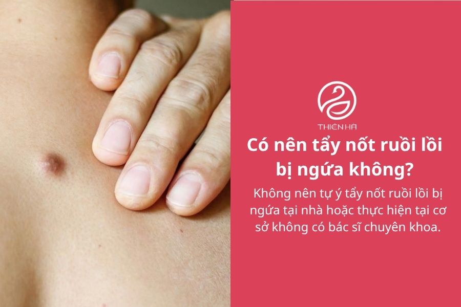 Nốt ruồi lồi bị ngứa: Nguyên nhân và cách xử lý an toàn 6 Có nên tẩy nốt ruồi lồi bị ngứa không?