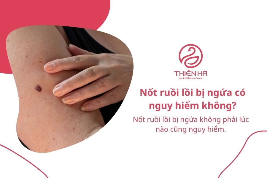 Nốt ruồi lồi bị ngứa: Nguyên nhân và cách xử lý an toàn 8 Câu hỏi thường gặp về nốt ruồi bị ngứa