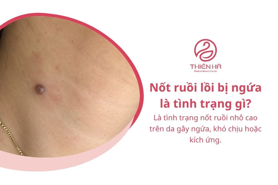 Nốt ruồi lồi bị ngứa: Nguyên nhân và cách xử lý an toàn 1 Nốt ruồi lồi bị ngứa là tình trạng gì?
