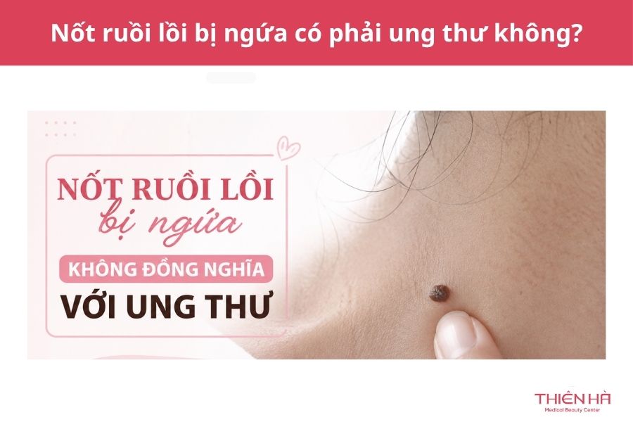 Nốt ruồi lồi bị ngứa: Nguyên nhân và cách xử lý an toàn 3 Nốt ruồi lồi bị ngứa có phải ung thư không?