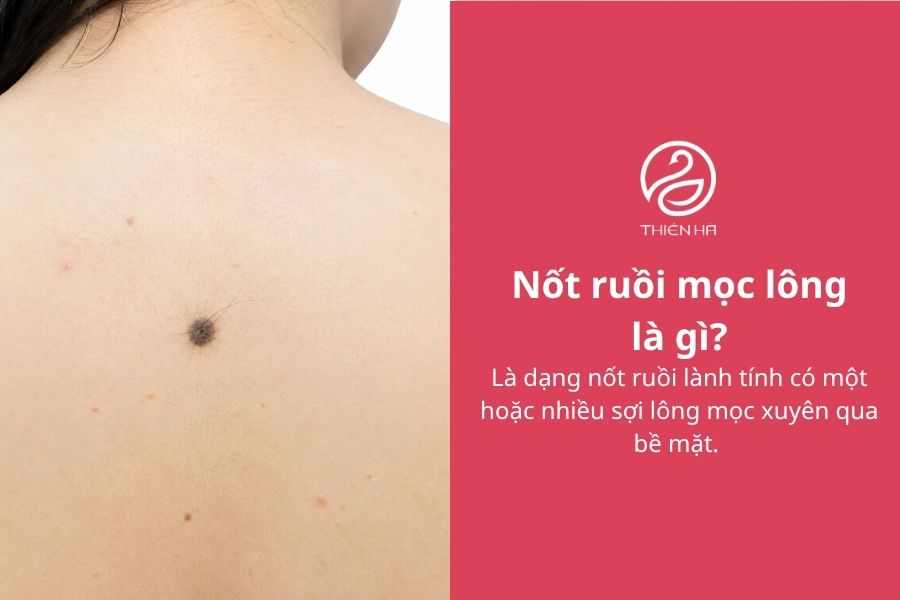 Nốt ruồi mọc lông: Nguyên nhân, mức độ nguy hiểm và cách xử lý 1 Nốt ruồi mọc lông là gì?