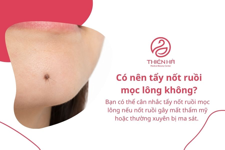 Nốt ruồi mọc lông: Nguyên nhân, mức độ nguy hiểm và cách xử lý 9 Câu hỏi thường gặp về nốt ruồi mọc lông