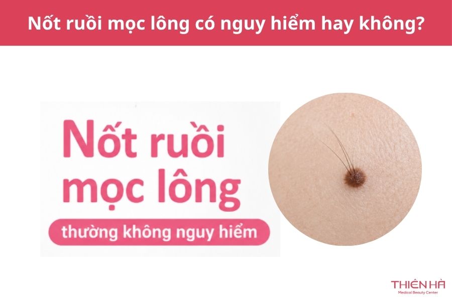 Nốt ruồi mọc lông: Nguyên nhân, mức độ nguy hiểm và cách xử lý 3 Nốt ruồi mọc lông có nguy hiểm không?