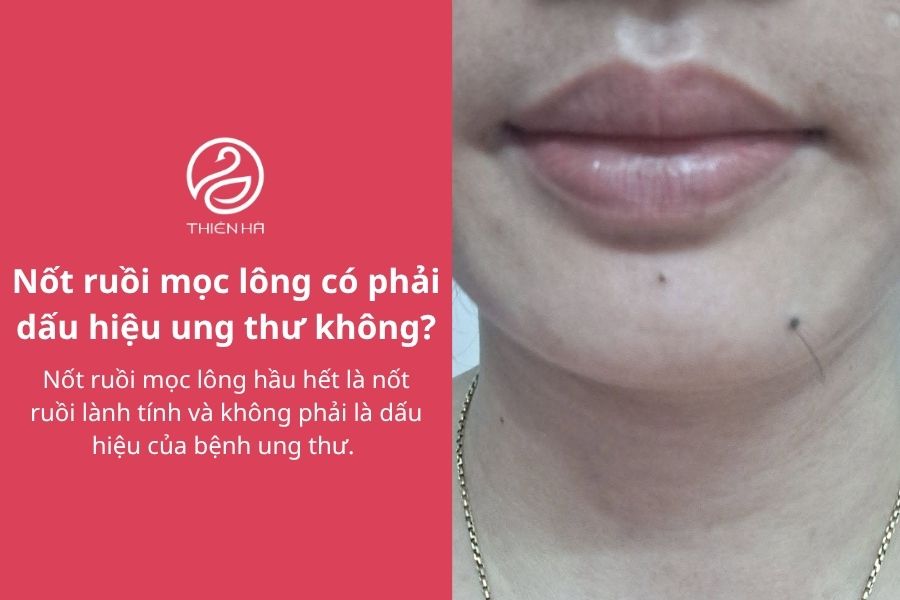 Nốt ruồi mọc lông: Nguyên nhân, mức độ nguy hiểm và cách xử lý 4 Nốt ruồi mọc lông có phải dấu hiệu ung thư không?