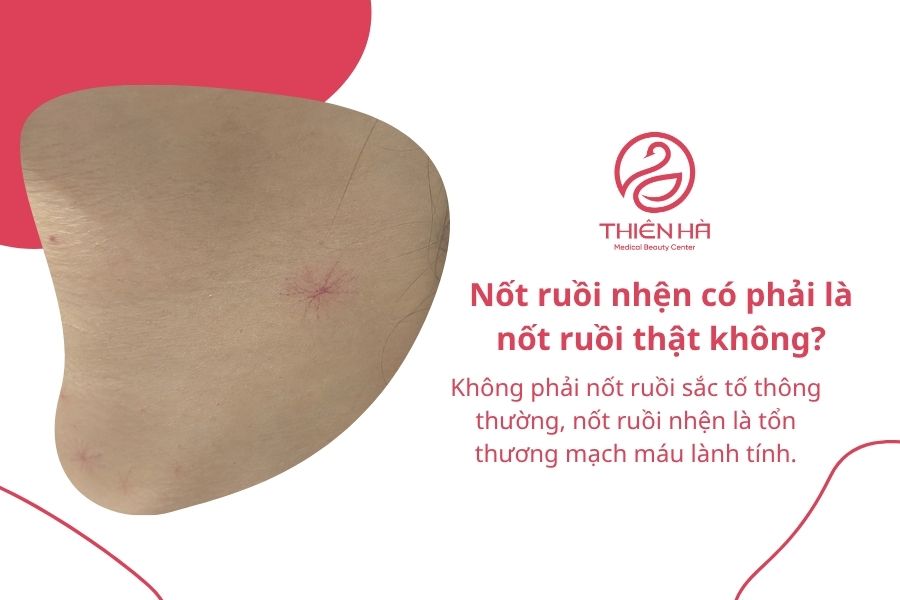 Nốt ruồi nhện có nguy hiểm không? Cách nhận biết và điều trị 8 Câu hỏi thường gặp về nốt ruồi nhện