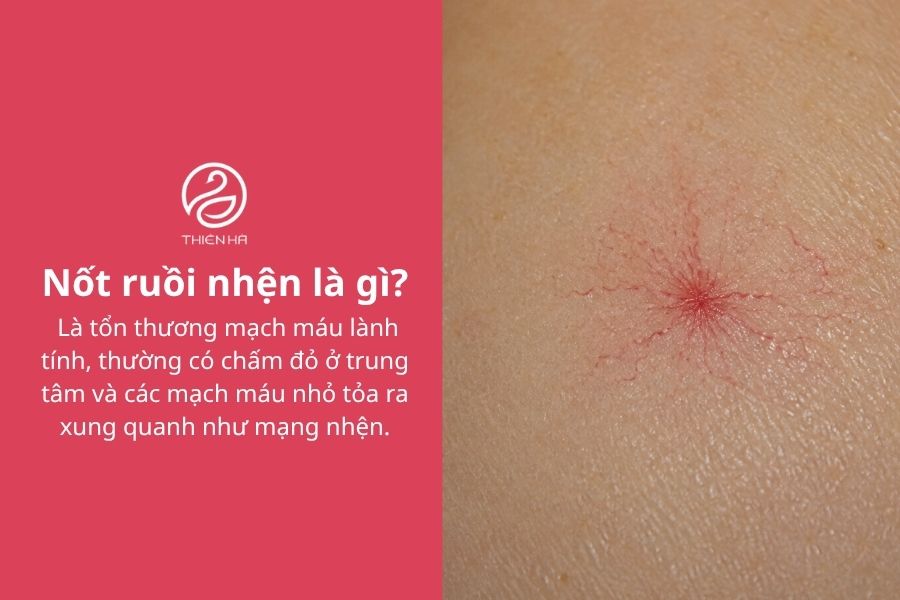 Nốt ruồi nhện có nguy hiểm không? Cách nhận biết và điều trị 1 Nốt ruồi nhện là gì?
