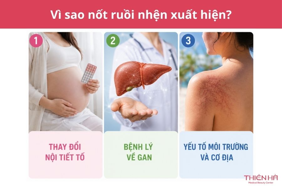 Nốt ruồi nhện có nguy hiểm không? Cách nhận biết và điều trị 3 Vì sao xuất hiện nốt ruồi nhện?