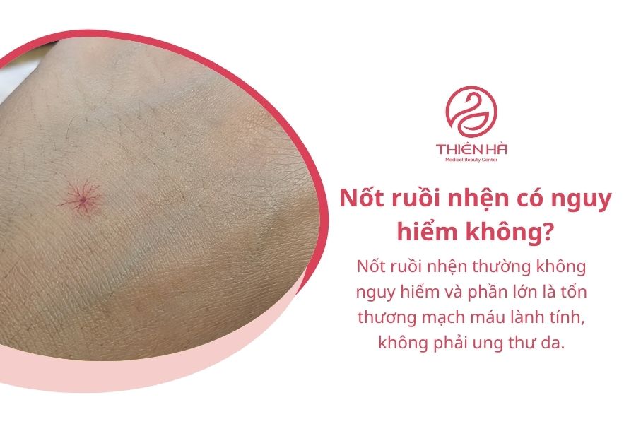 Nốt ruồi nhện có nguy hiểm không? Cách nhận biết và điều trị 4 Nốt ruồi nhện có nguy hiểm không?