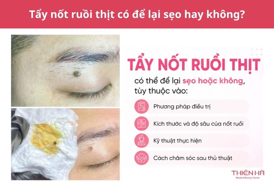 Nốt ruồi thịt là gì? Nguyên nhân, cách nhận biết và xử lý an toàn 7 Tẩy nốt ruồi thịt có để lại sẹo không?