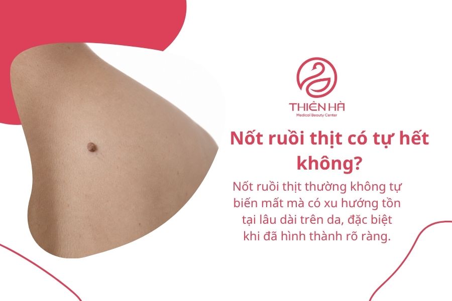 Nốt ruồi thịt là gì? Nguyên nhân, cách nhận biết và xử lý an toàn 9 Câu hỏi thường gặp về nốt ruồi thịt