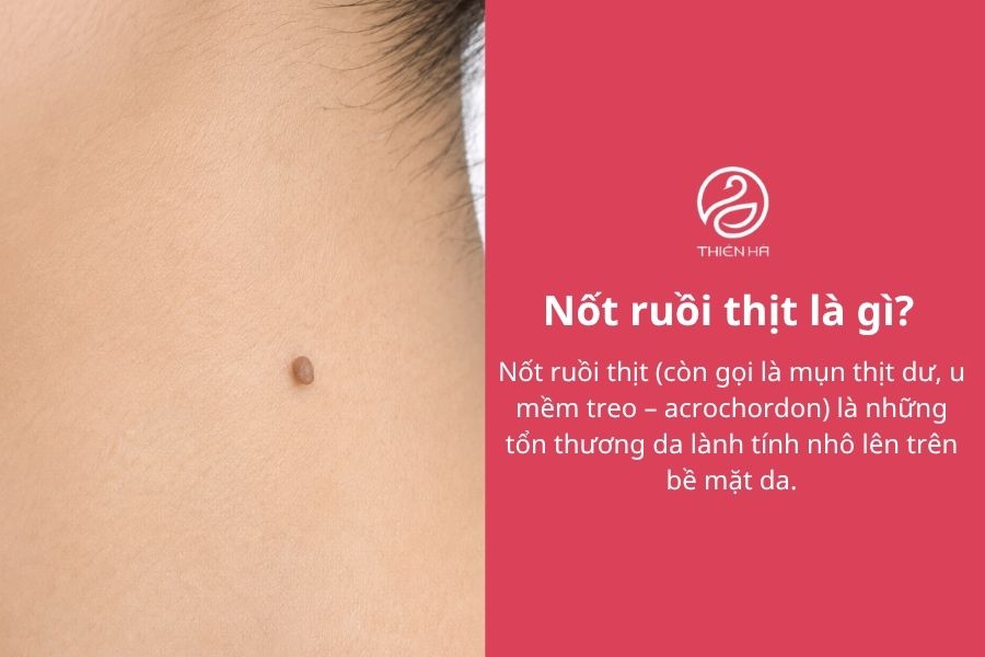 Nốt ruồi thịt là gì? Nguyên nhân, cách nhận biết và xử lý an toàn 1 Nốt ruồi thịt là gì? Đặc điểm nhận biết