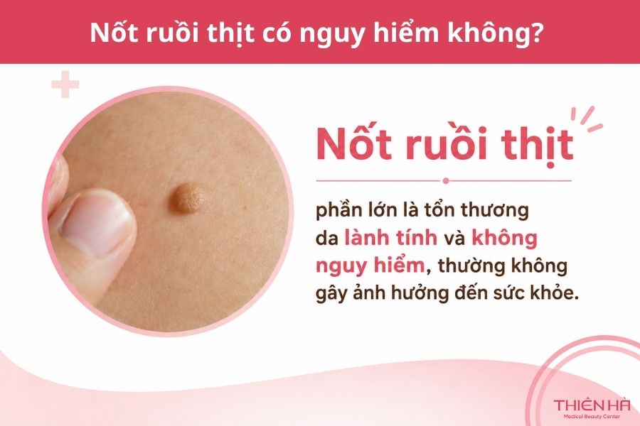 Nốt ruồi thịt là gì? Nguyên nhân, cách nhận biết và xử lý an toàn 3 Nốt ruồi thịt có nguy hiểm không?