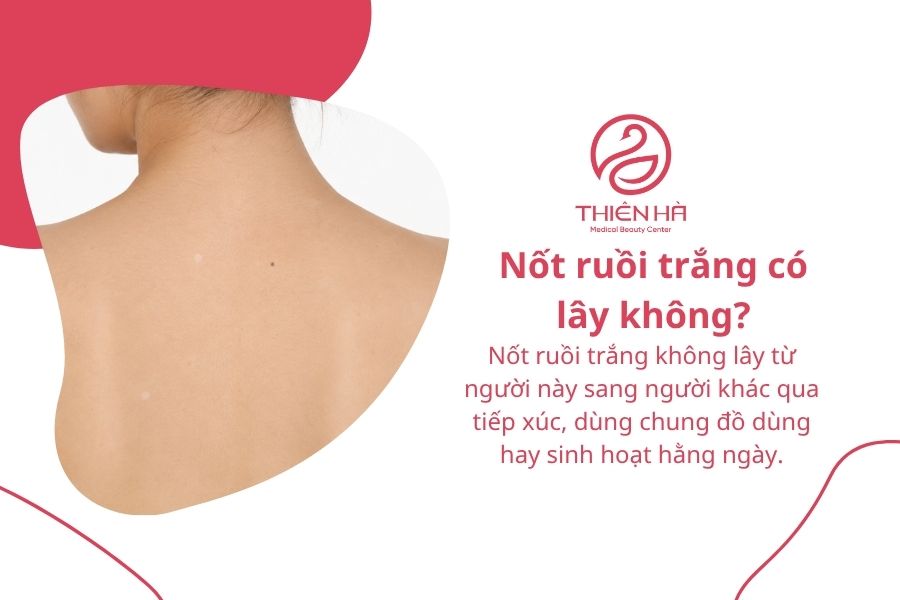 Nốt ruồi trắng: Nguyên nhân, mức độ nguy hiểm và cách xử lý 9 Câu hỏi thường gặp về nốt ruồi trắng