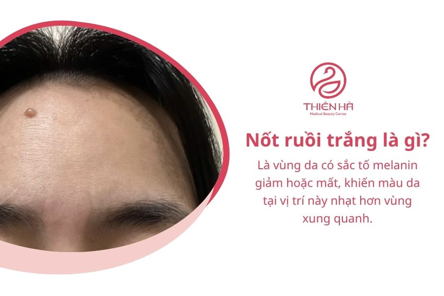 Nốt ruồi trắng: Nguyên nhân, mức độ nguy hiểm và cách xử lý 1 Nốt ruồi trắng là gì?