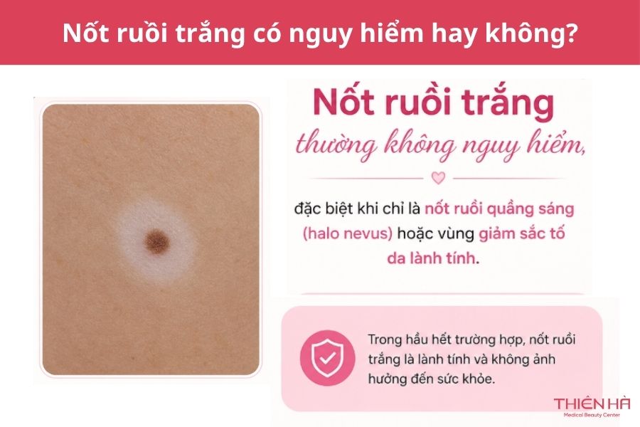 Nốt ruồi trắng: Nguyên nhân, mức độ nguy hiểm và cách xử lý 3 Nốt ruồi trắng có nguy hiểm không?