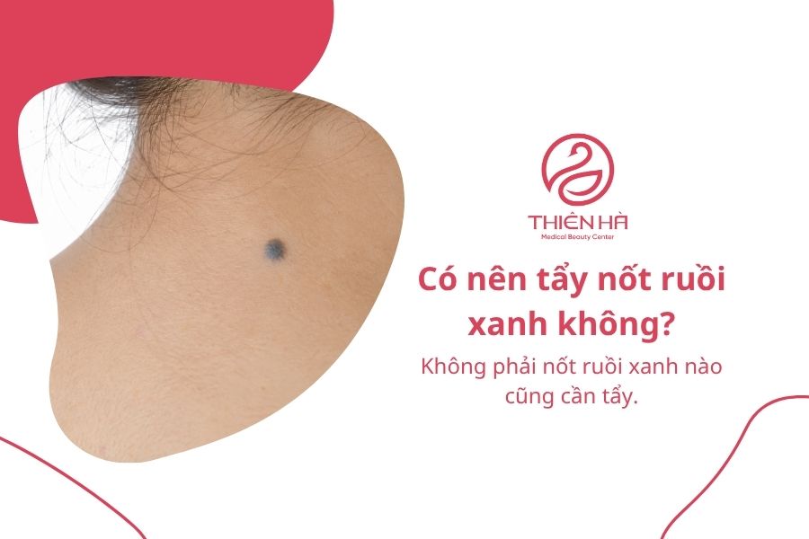 Nốt ruồi xanh có nguy hiểm không? Đặc điểm và cách xử lý phù hợp 9 Câu hỏi thường gặp về nốt ruồi xanh