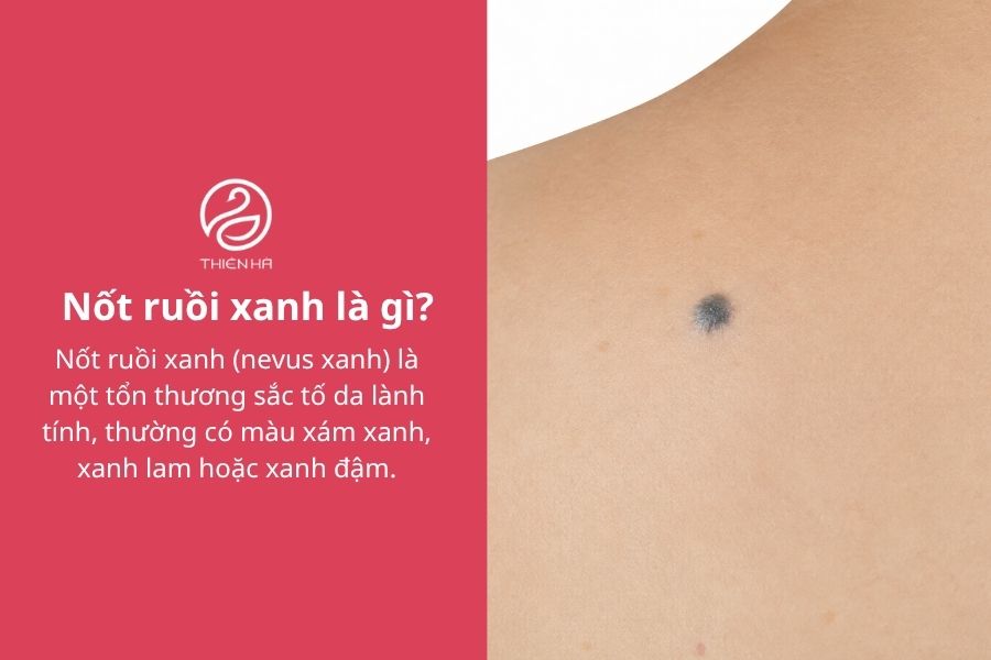 Nốt ruồi xanh có nguy hiểm không? Đặc điểm và cách xử lý phù hợp 1 Nốt ruồi xanh là gì?