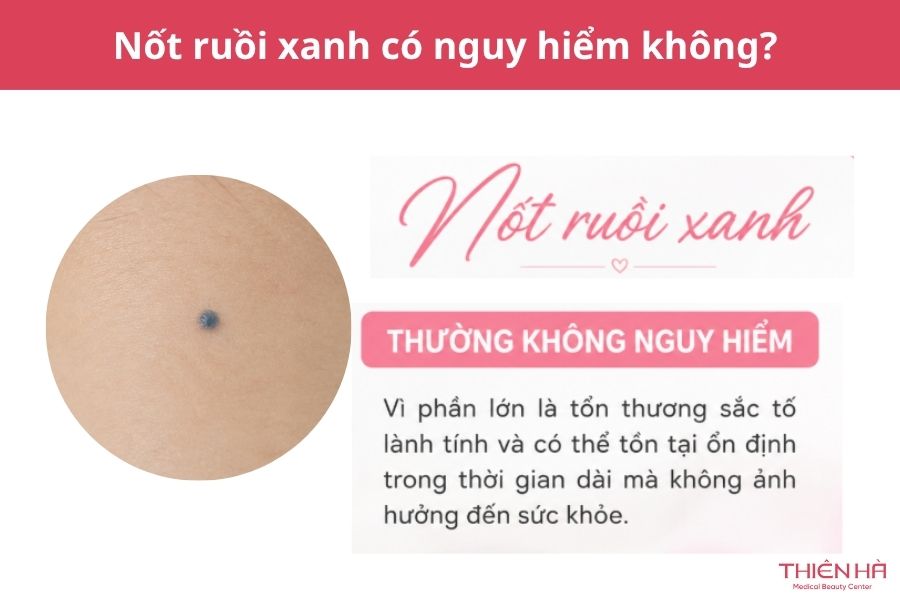 Nốt ruồi xanh có nguy hiểm không? Đặc điểm và cách xử lý phù hợp 5 Nốt ruồi xanh có nguy hiểm không?