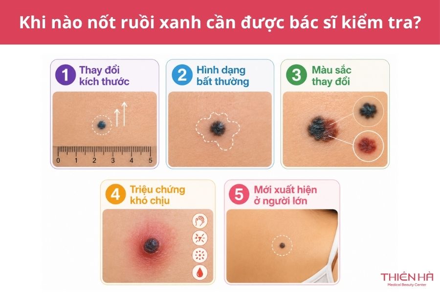 Nốt ruồi xanh có nguy hiểm không? Đặc điểm và cách xử lý phù hợp 6 Khi nào nốt ruồi xanh cần được bác sĩ kiểm tra?