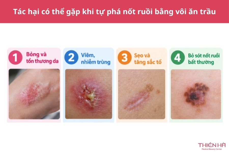 Tác hại có thể gặp khi tự phá nốt ruồi bằng vôi ăn trầu
