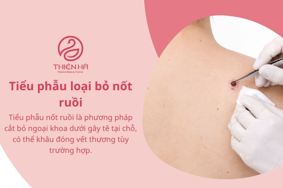 Tiểu phẫu loại bỏ nốt ruồi