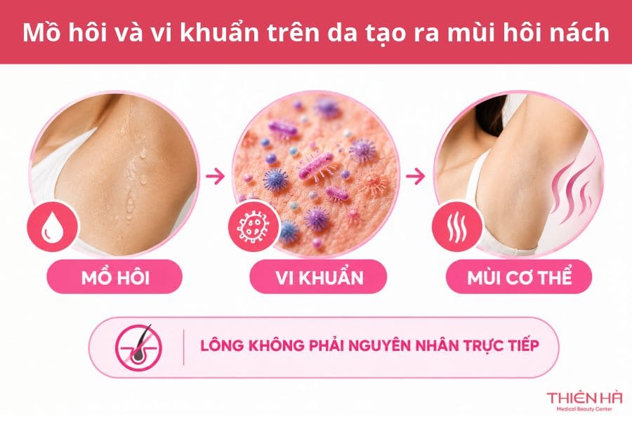 Tại sao triệt lông nách lại bị hôi nách? Cách xử lý 3 Tại sao triệt lông nách lại bị hôi nách: Do mồ hôi và vi khuẩn trên da tạo ra mùi