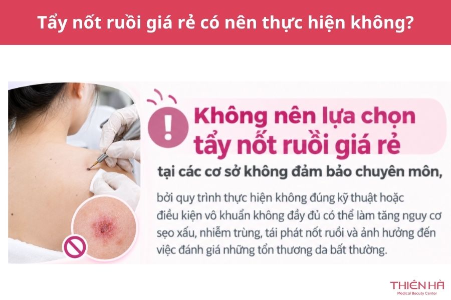 Tẩy nốt ruồi giá rẻ có nên thực hiện không?
