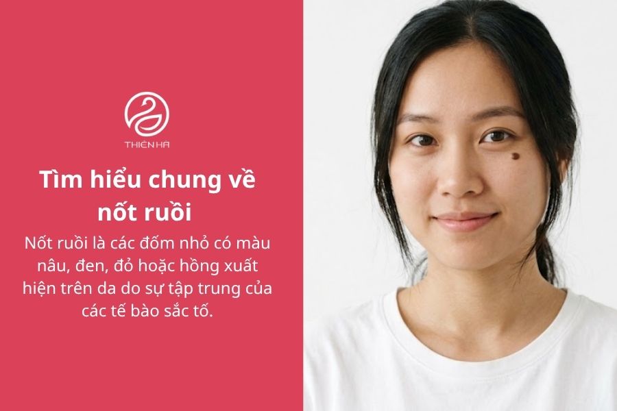 Tìm hiểu chung về nốt ruồi 