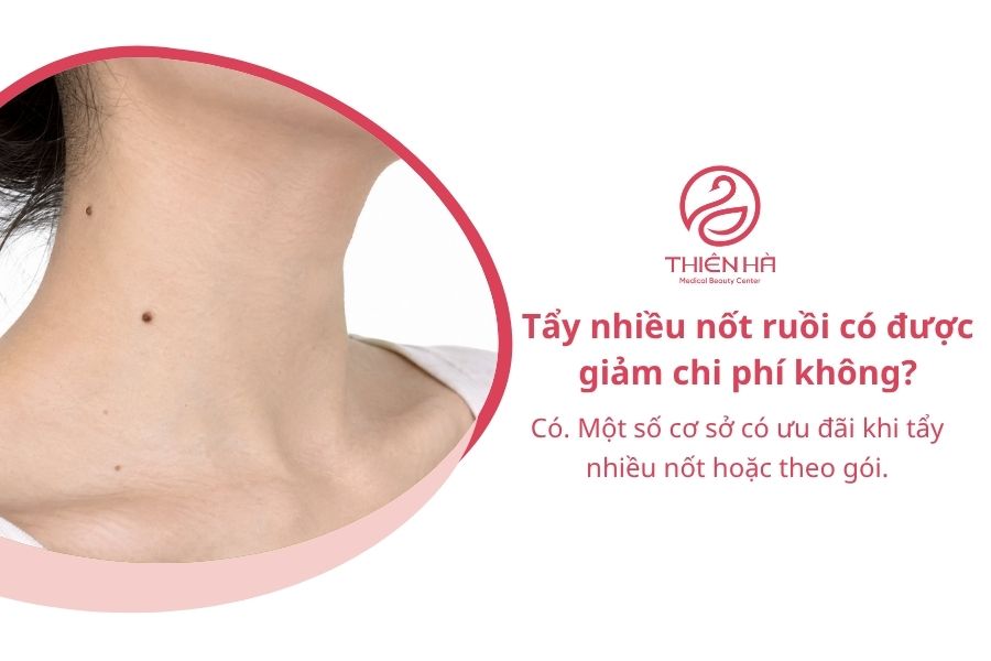 Câu hỏi thường gặp về chi phí tẩy nốt ruồi