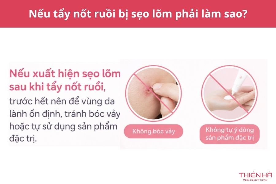 Tẩy nốt ruồi có để lại sẹo không? Nguyên nhân và cách hạn chế 8 Câu hỏi thường gặp về tẩy nốt ruồi và sẹo