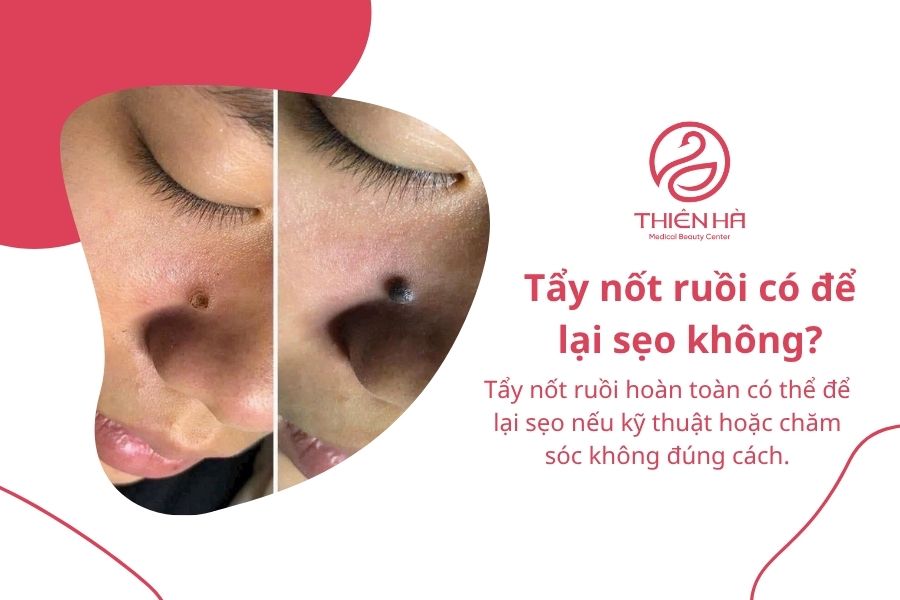 Tẩy nốt ruồi có để lại sẹo không? Nguyên nhân và cách hạn chế 1 Tẩy nốt ruồi có để lại sẹo không?