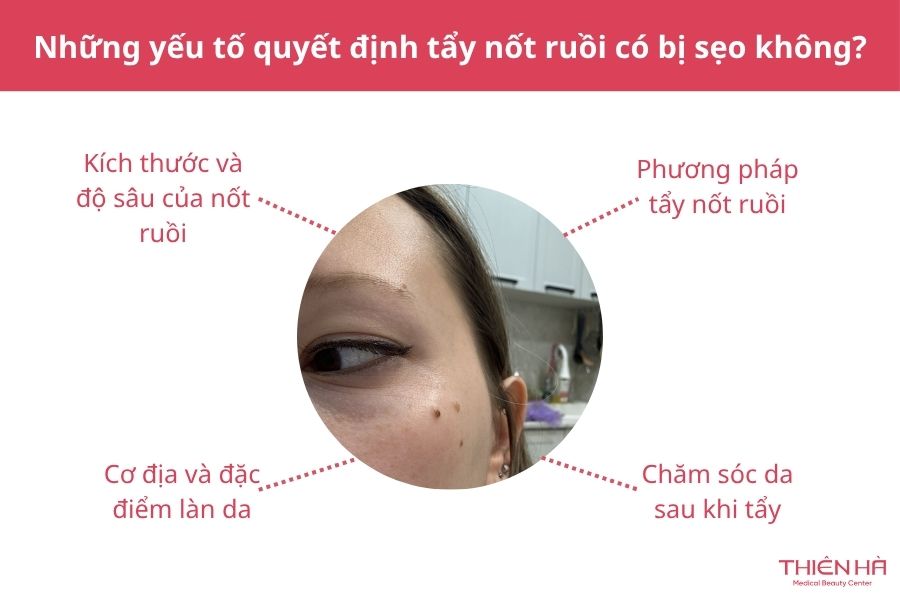 Tẩy nốt ruồi có để lại sẹo không? Nguyên nhân và cách hạn chế 4 Những yếu tố quyết định tẩy nốt ruồi có bị sẹo không?