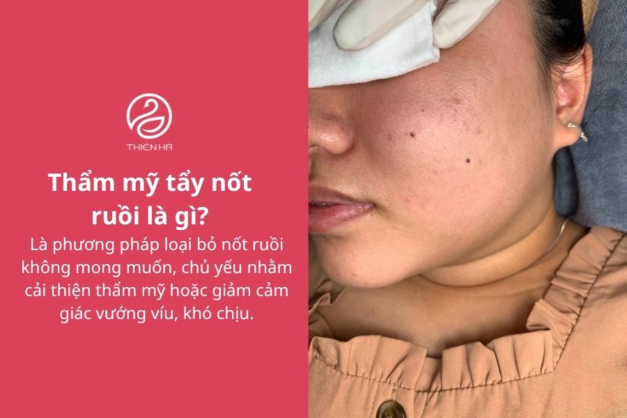 Thẩm mỹ tẩy nốt ruồi: Phương pháp, chi phí và lưu ý an toàn 1 Thẩm mỹ tẩy nốt ruồi là gì?