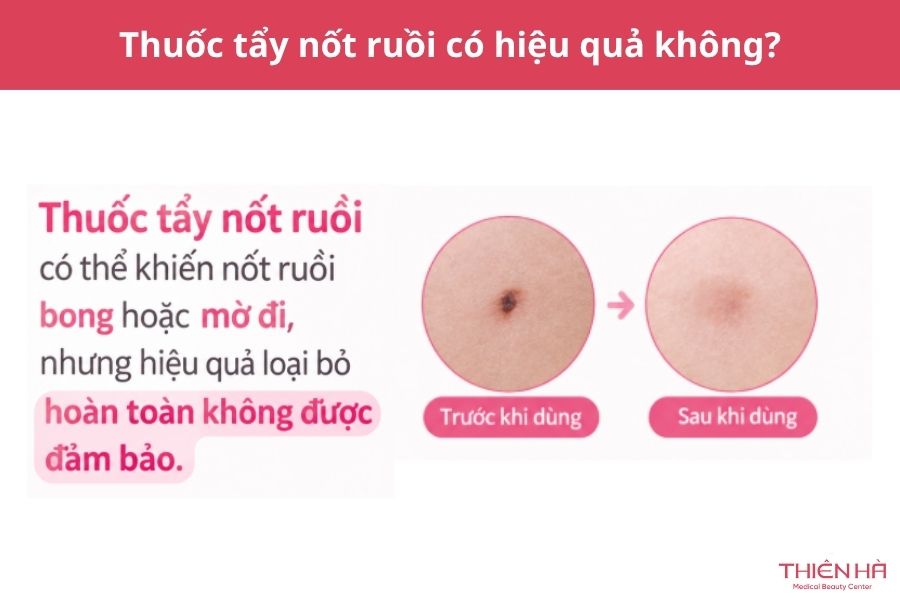Thuốc tẩy nốt ruồi có hiệu quả không?