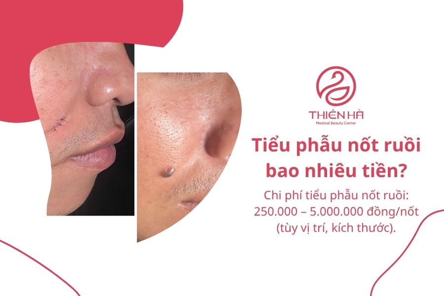 Tiểu phẫu nốt ruồi là gì? Quy trình, chi phí và cách chăm sóc 5 Tiểu phẫu nốt ruồi bao nhiêu tiền?