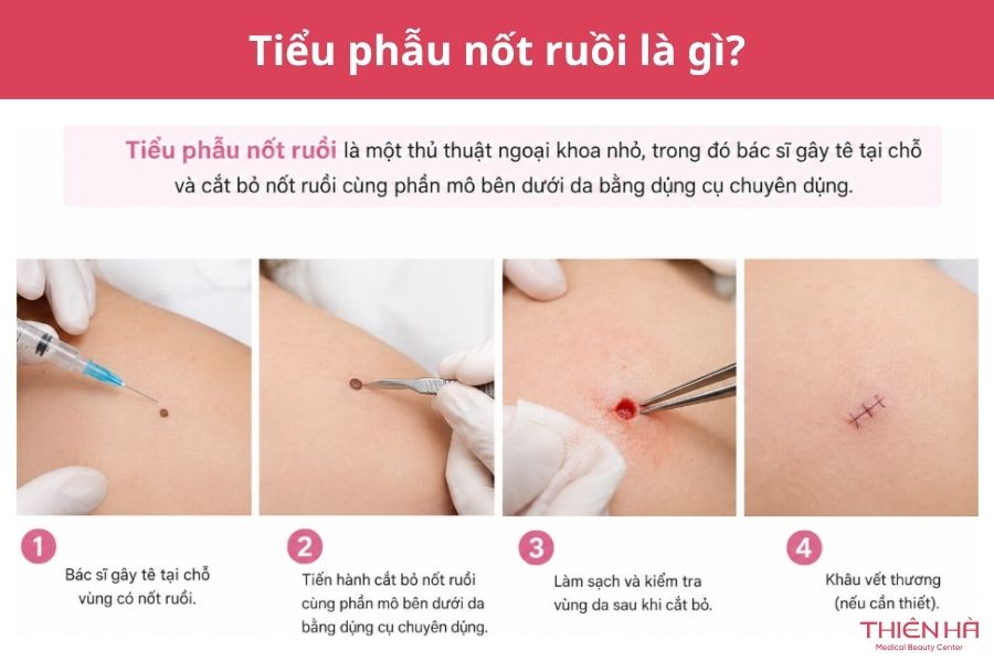 Tiểu phẫu nốt ruồi là gì? Quy trình, chi phí và cách chăm sóc 1 Tiểu phẫu nốt ruồi là gì?