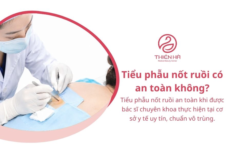 Tiểu phẫu nốt ruồi là gì? Quy trình, chi phí và cách chăm sóc 4 Tiểu phẫu nốt ruồi có an toàn không?