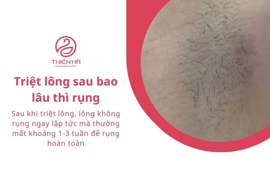 Triệt lông bao nhiêu lần thì hết? Giải đáp chi tiết 3 Triệt lông bao lâu thì rụng?