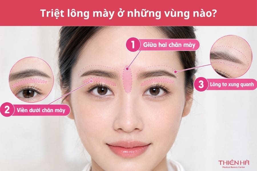 Triệt lông mày là gì? Có nên thực hiện không? 3 Triệt lông mày ở những vùng nào?