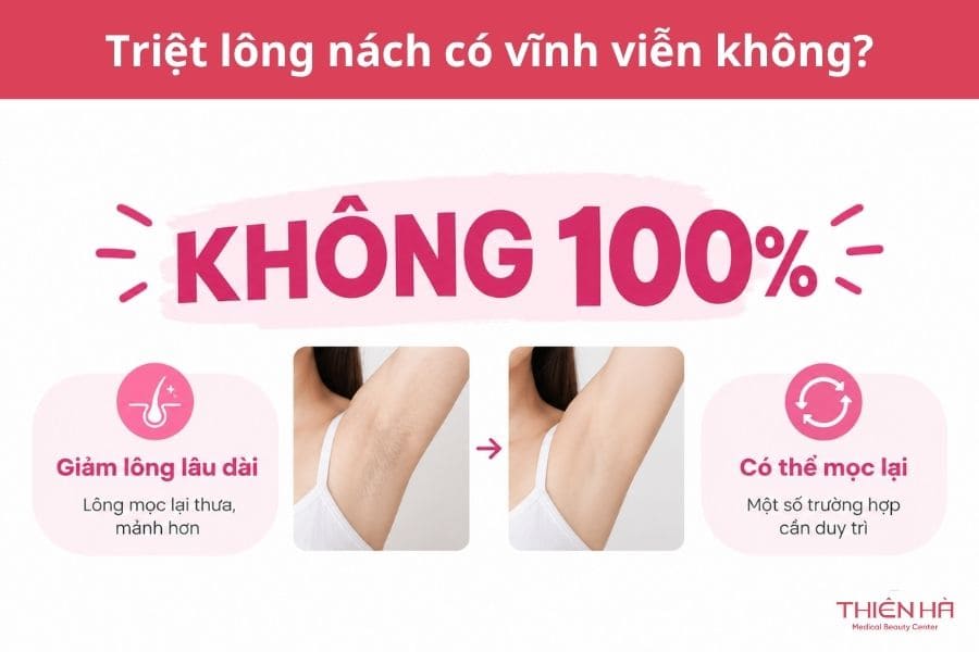 Triệt lông nách có vĩnh viễn không?