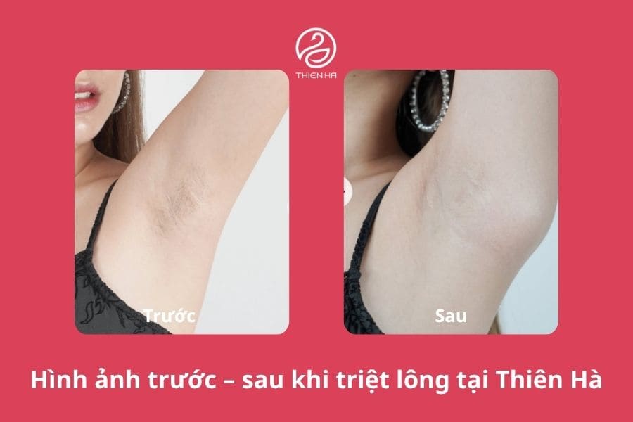 Hình ảnh thực tế trước và sau khi triệt lông vùng nách tại Thẩm mỹ viện Thiên Hà