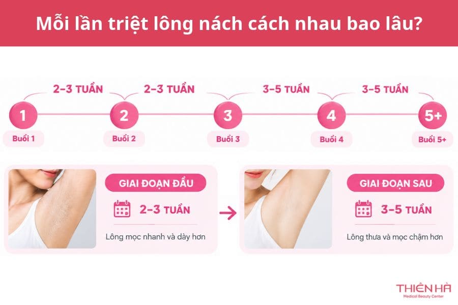 Triệt lông nách bao nhiêu lần thì hết? 2 Mỗi lần triệt lông nách cách nhau bao lâu?