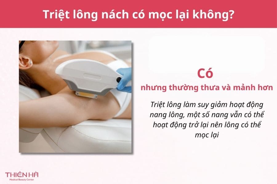 Triệt lông nách bao nhiêu lần thì hết? 4 Triệt lông nách có mọc lại không?