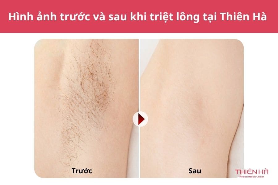 Triệt lông toàn thân là gì? Có nên thực hiện không? 9 Hình ảnh thực tế sau khi trải nghiệm dịch vụ triệt lông toàn thân công nghệ cao tại Thẩm mỹ viện Thiên Hà