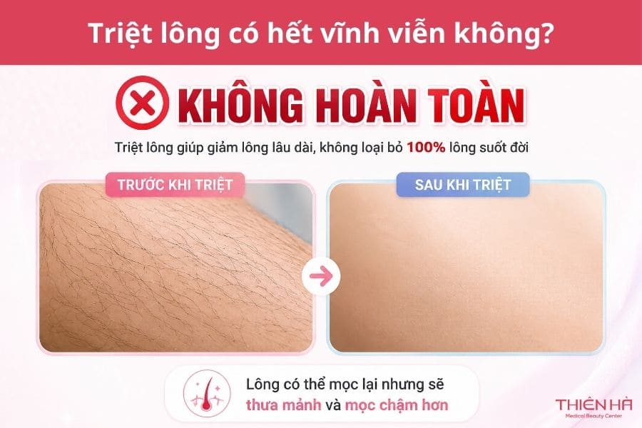 Triệt lông vĩnh viễn giúp giảm đáng kể sự phát triển của lông trong thời gian dài, nhưng không đảm bảo loại bỏ 100% lông suốt đời