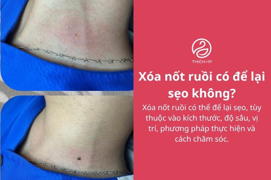 Xóa nốt ruồi an toàn: Phương pháp, chi phí và cách hạn chế sẹo 5 Xóa nốt ruồi có để lại sẹo không?