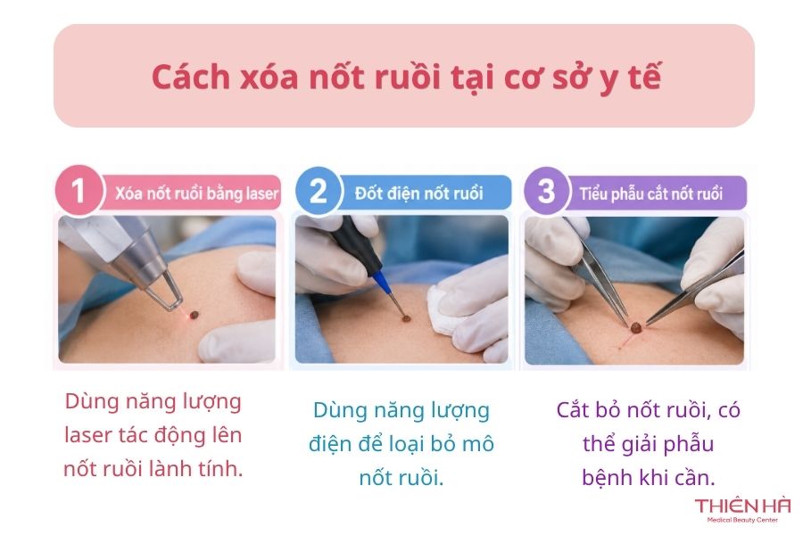 Xóa nốt ruồi an toàn: Phương pháp, chi phí và cách hạn chế sẹo 4 Cách xóa nốt ruồi tại cơ sở y tế – An toàn và hiệu quả cao